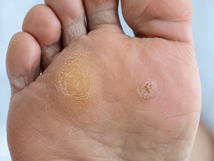 Calo e verruga plantar na sola do pé
